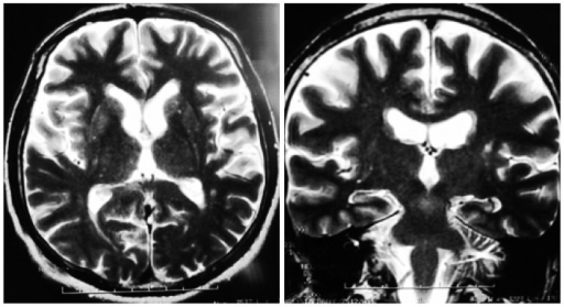 Frontal lobe dementia gambling disorder Frontal lobe dementia gambling disorder
